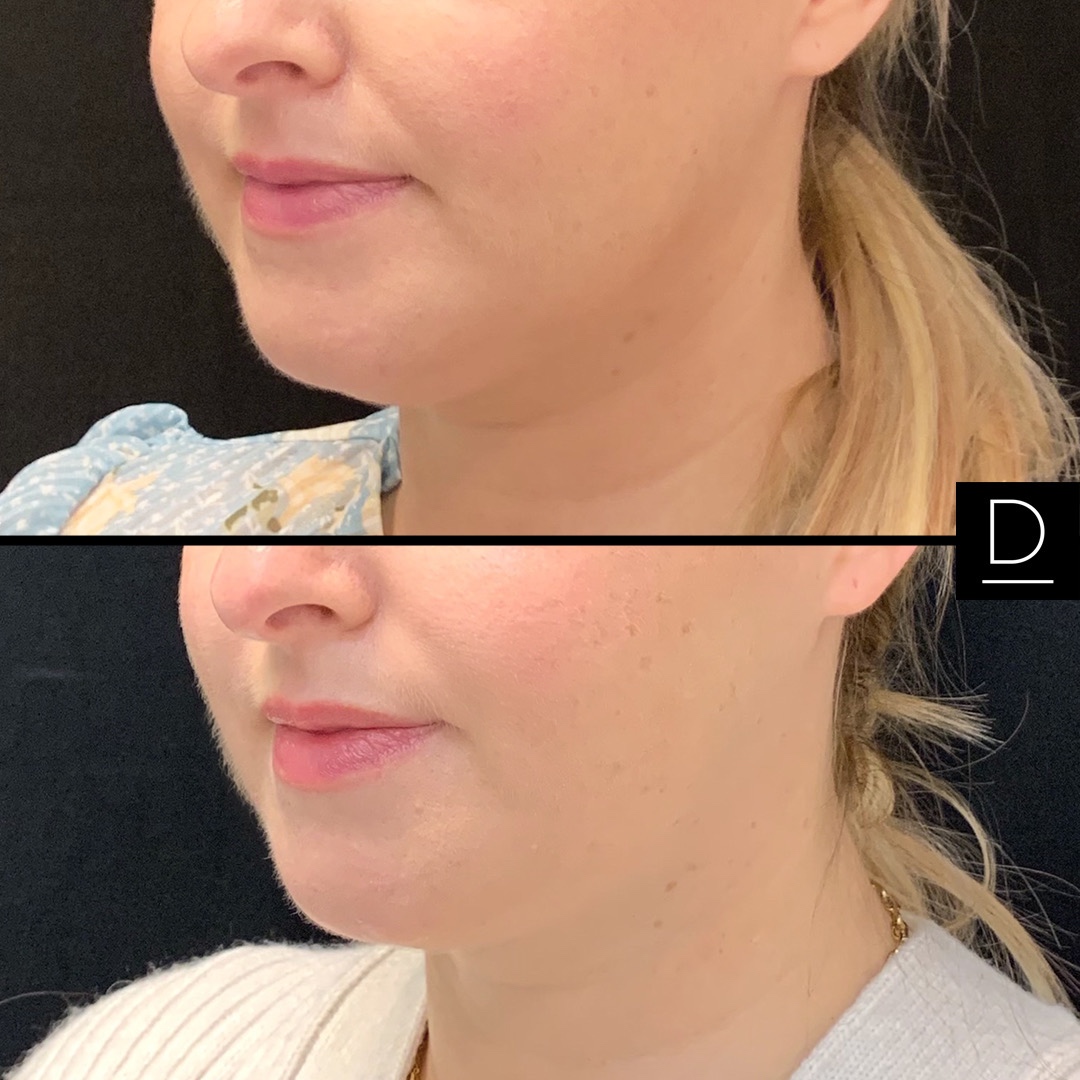 CoolSculpting Before & After